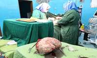 خارج سازی توده 4 کیلویی از شکم بانوی آستارایی